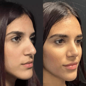 The Best Rhinoplasty Surgeon in Dubai: Reviews, Results, and Costs