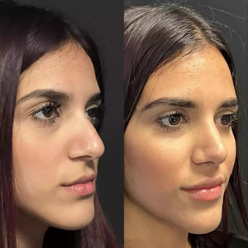 The Best Rhinoplasty Surgeon in Dubai: Reviews, Results, and Costs