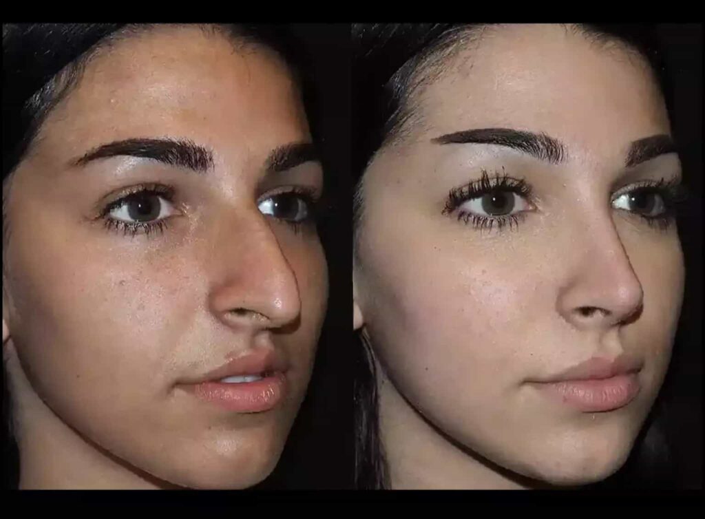 septoplasty in dubai