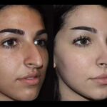 Best Septoplasty Surgeon in Dubai: Restoring Nasal Function with Care