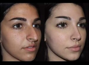 Best Septoplasty Surgeon in Dubai: Restoring Nasal Function with Care