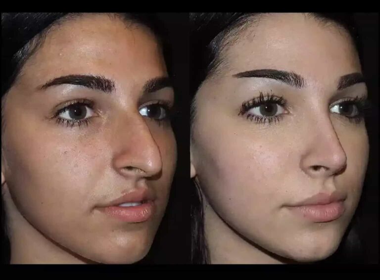 Best Septoplasty Surgeon in Dubai: Restoring Nasal Function with Care