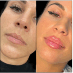 Discover Natural-Looking Results with Fillers in Dubai