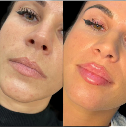 Discover Natural-Looking Results with Fillers in Dubai
