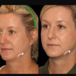 Why Choose Sculptra Fillers Treatments in Dubai Over Surgery