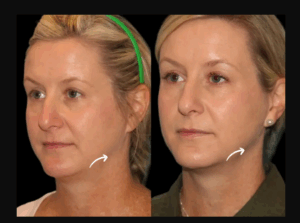 Why Choose Sculptra Fillers Treatments in Dubai Over Surgery