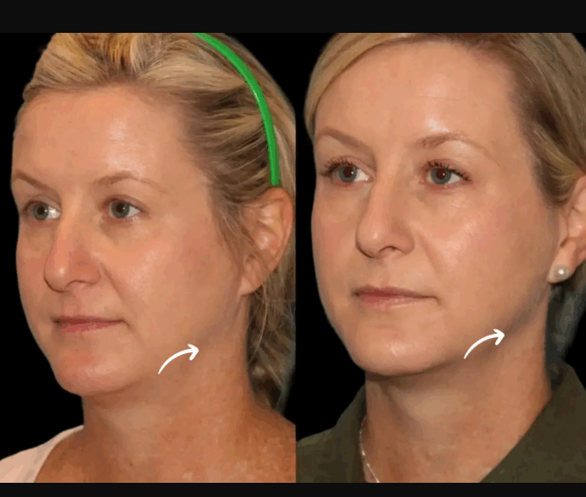 Why Choose Sculptra Fillers Treatments in Dubai Over Surgery