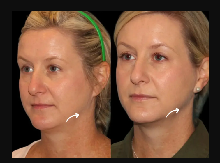 sculptra fillers