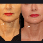 Sculptra Fillers for Wrinkles by Best Doctors in Dubai