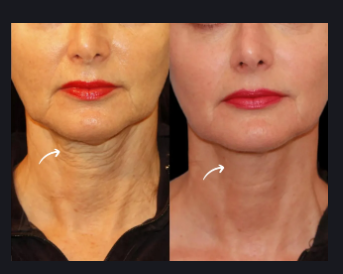 Sculptra Fillers for Wrinkles by Best Doctors in Dubai