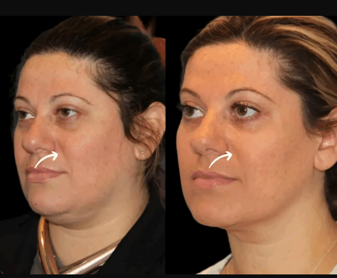 Sculptra Fillers and Self-Care: Best Doctors in Dubai Share Their Favorite Rituals