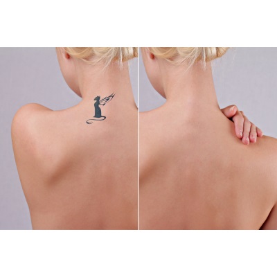 IPL vs. Q-Switched Laser: Which Tattoo Removal Method is Best?