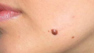 Why Choose Copper Valley Medical For Skin Tag Removal?