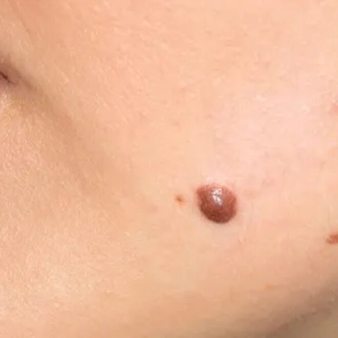 Why Choose Copper Valley Medical For Skin Tag Removal?