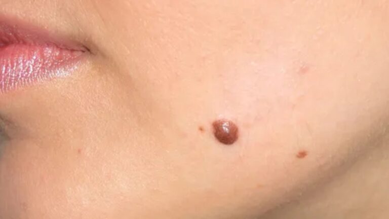 Why Choose Copper Valley Medical For Skin Tag Removal?
