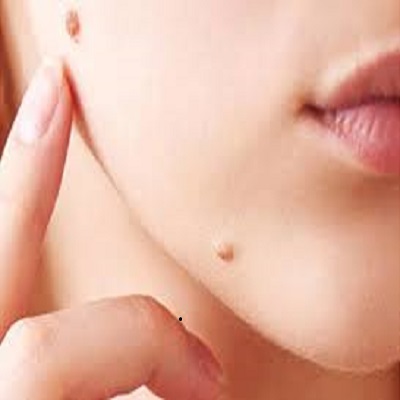 What to Expect During Your Wart Removal Appointment