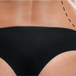 Body Contouring in Dubai: Achieve Your Ideal Shape with Customized Solutions