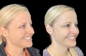 Experience Smooth Results at the Best Aesthetic Clinics in Dubai for Botox