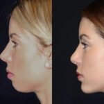 Chin Fillers Treatments in Dubai: The Best Non-Surgical Enhancement for Your Chin