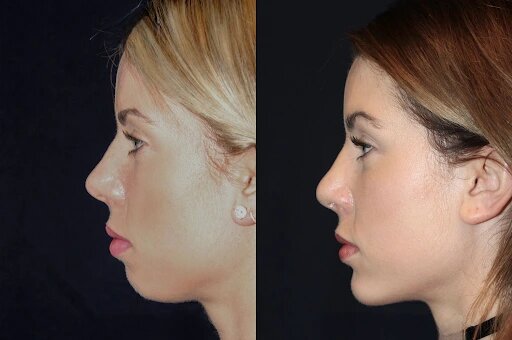 Chin Fillers Treatments in Dubai: The Best Non-Surgical Enhancement for Your Chin