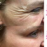 Dysport Before and After – What You Should Know