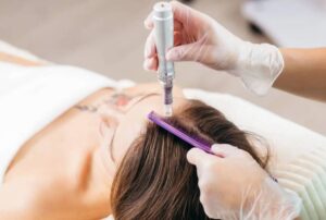 PRP for Hair: A Industry That Keeps Growing