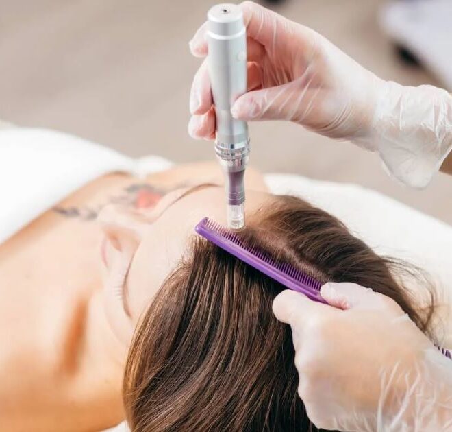 PRP for Hair: A Industry That Keeps Growing