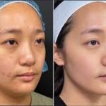 Before and After Results of Morpheus8 in Dubai