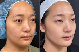Before and After Results of Morpheus8 in Dubai