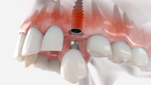 Understanding Immediate Load Implants in Dubai: Benefits and Procedure Overview