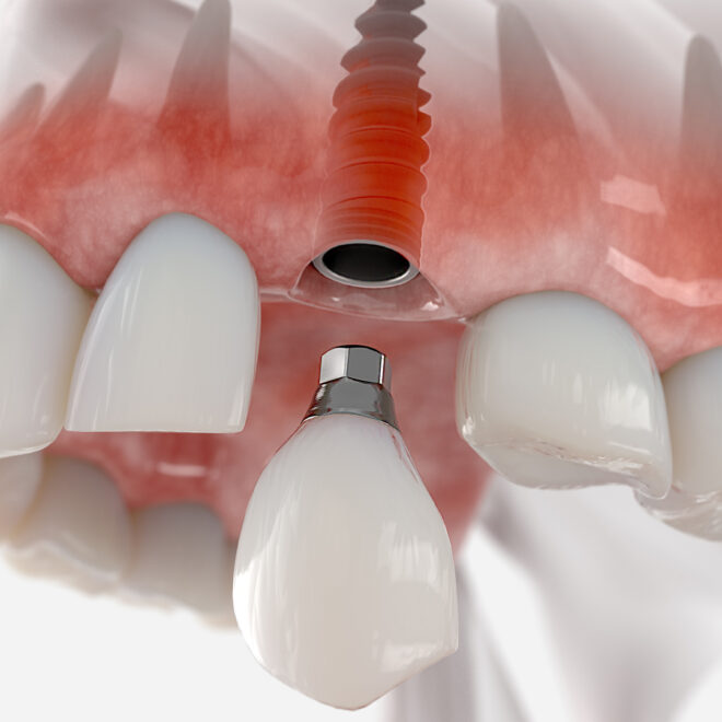 Understanding Immediate Load Implants in Dubai: Benefits and Procedure Overview