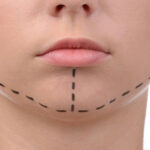 Dermal Fillers for Jawline Contouring at Dynamic Aesthetic Clinic