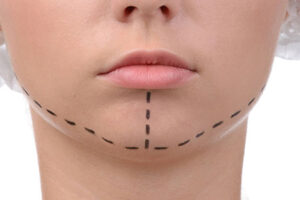 Dermal Fillers for Jawline Contouring at Dynamic Aesthetic Clinic