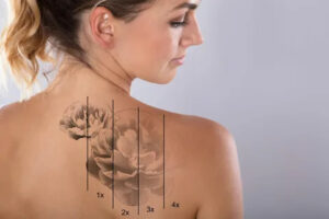 Limited-Time Offers: Tattoo Removal in Islamabad Under 10K