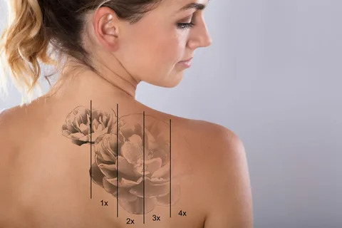 laser tattoo removal in Islamabad
