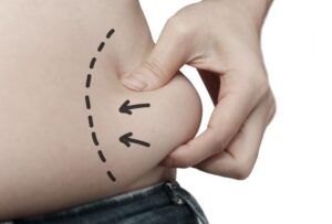 Model Measurements, Medical Means: How Liposuction Fits Fashion’s Frame
