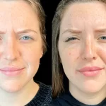 Best Plastic Surgeons in dubai Explain How Botox Can Boost Your Confidence