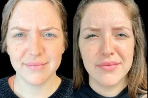 Best Plastic Surgeons in dubai Explain How Botox Can Boost Your Confidence