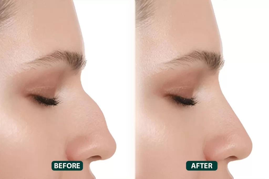 What Makes Ultrasonic Rhinoplasty Dubai a Game-Changer in Nose Surgery?