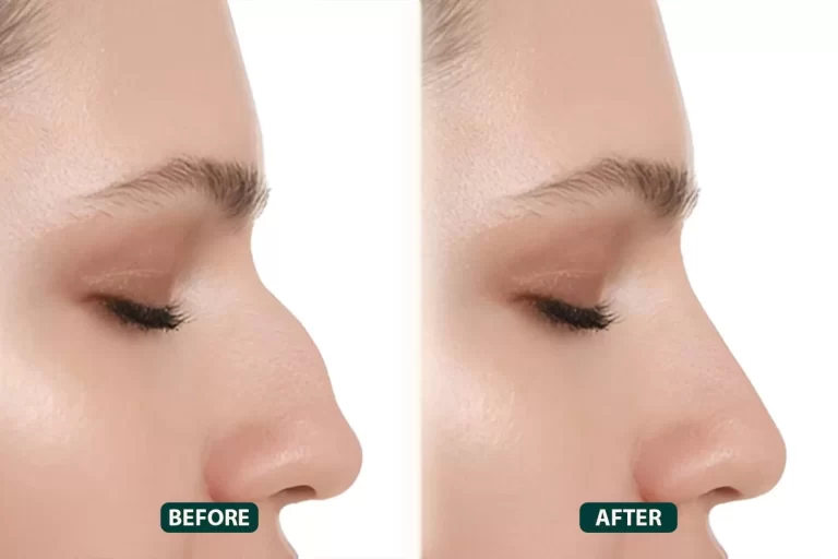 What Makes Ultrasonic Rhinoplasty Dubai a Game-Changer in Nose Surgery?