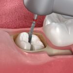 How to Deal with the Pain of Root Canals: Ottawa Dental Tips