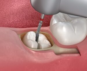 How to Deal with the Pain of Root Canals: Ottawa Dental Tips
