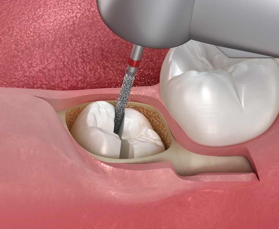 root canals pain relief