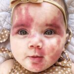 Comprehensive Port Wine Stain Treatment Plans at Dynamic Aesthetic Clinic