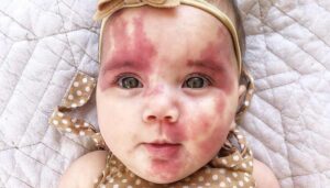 Comprehensive Port Wine Stain Treatment Plans at Dynamic Aesthetic Clinic