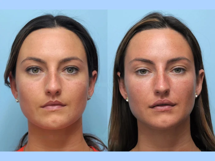 Experience Instant Lift with Thread Lift Treatments in Dubai