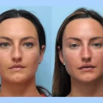 Achieve a Sculpted Face at the Best Aesthetic Clinics in Dubai for Thread Lift