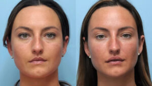 Benefits of Choosing Thread Lift Treatment in Dubai Over Surgery