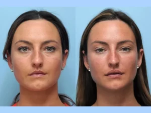 Achieve a Sculpted Face at the Best Aesthetic Clinics in Dubai for Thread Lift