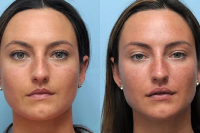 Benefits of Choosing Thread Lift Treatment in Dubai Over Surgery